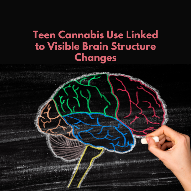 Teen Cannabis Use Linked to Visible Brain Structure Changes